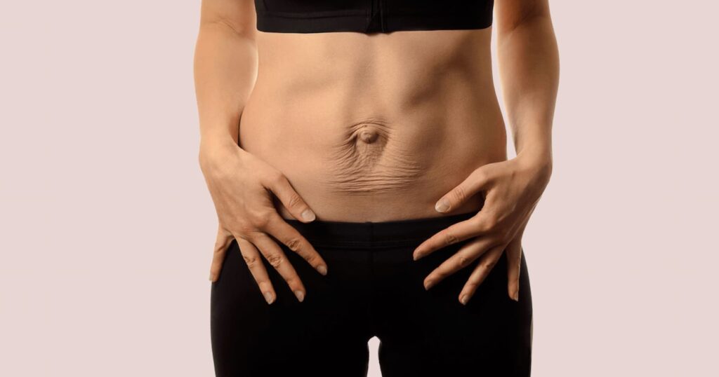 belly with Diastasis Recti